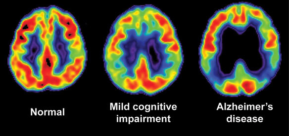 alzheimers_disease