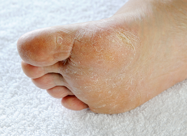 remedies for athlete's foot