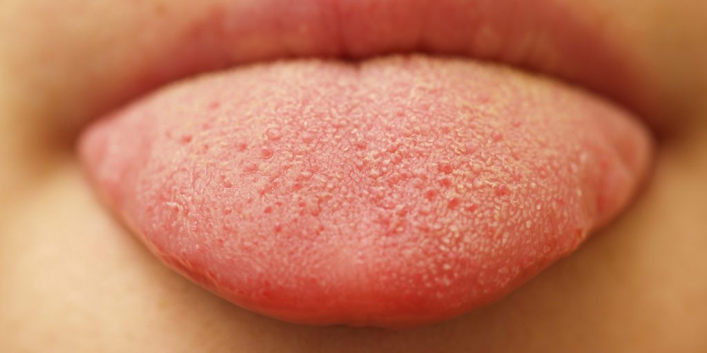 Burning Tongue Syndrome – Symptoms, Causes, Home Remedies and Relief