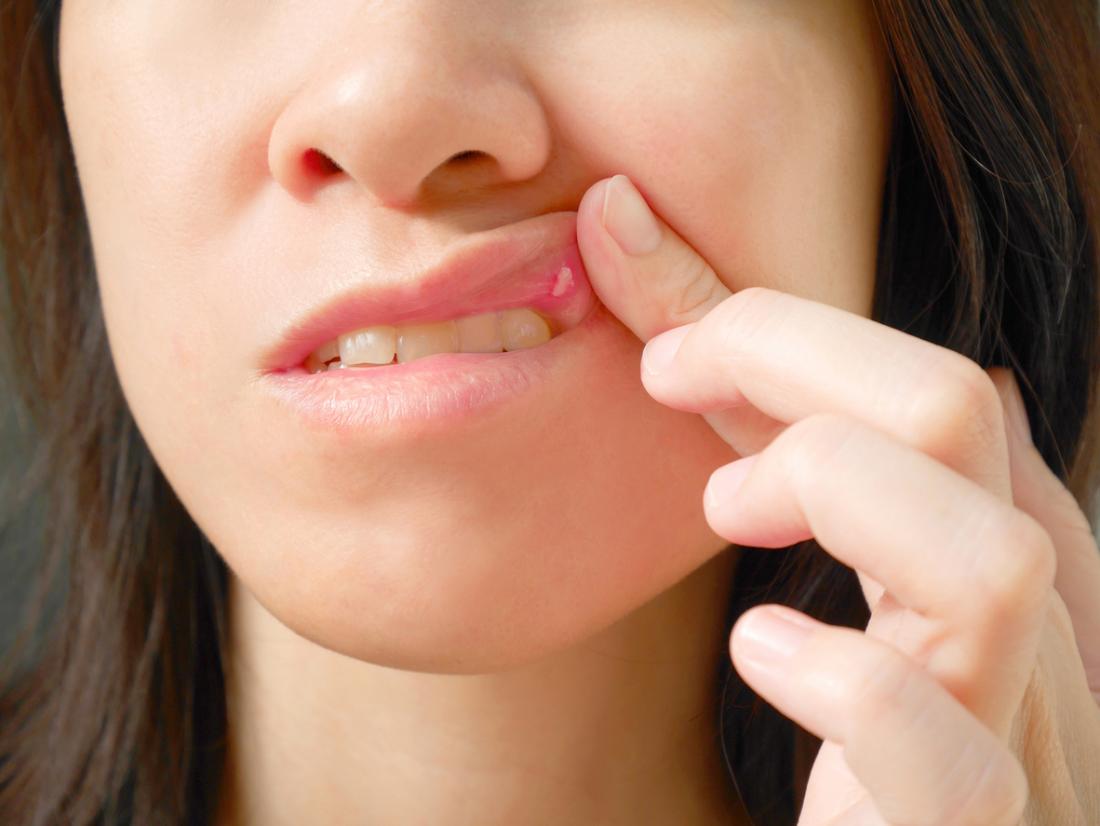 women with canker sore