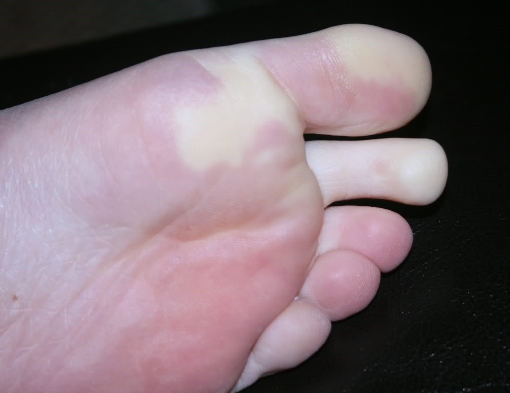 chilblains