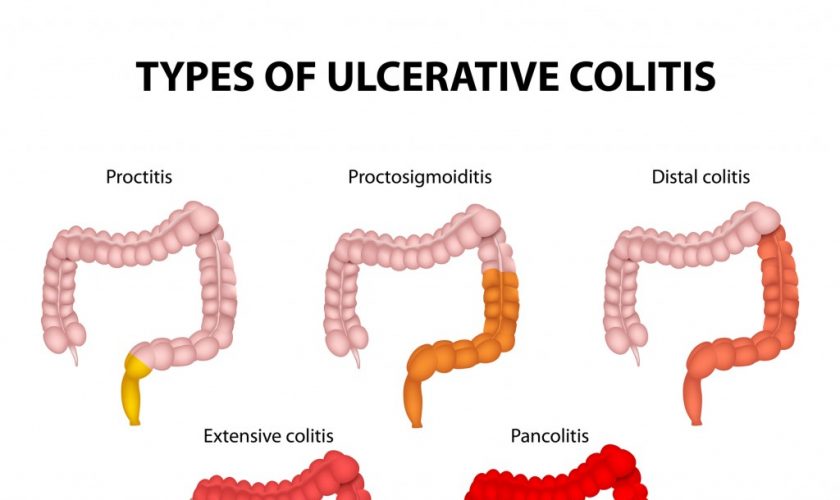 ulcerative_colitis