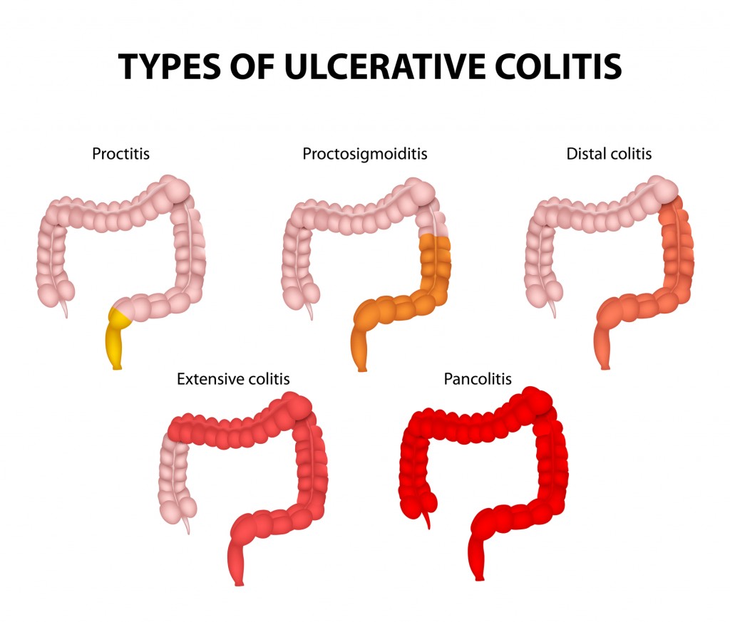 types of ulcerative colitis
