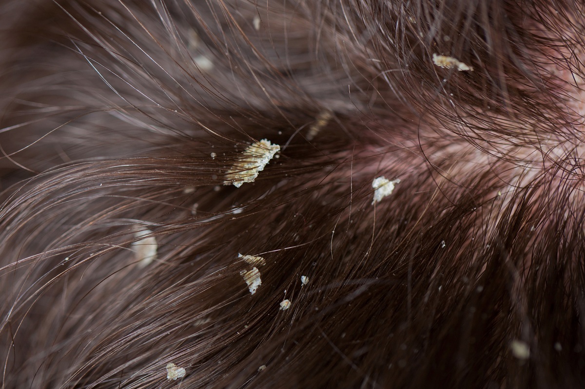 natural dandruff remedies