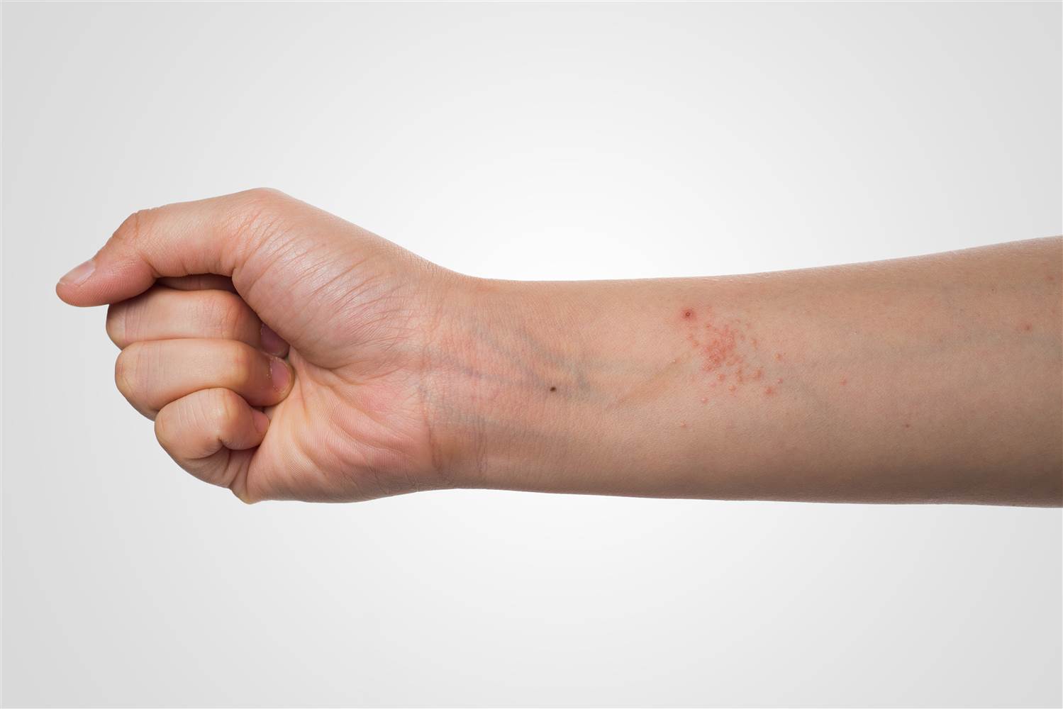 natural remedies for eczema