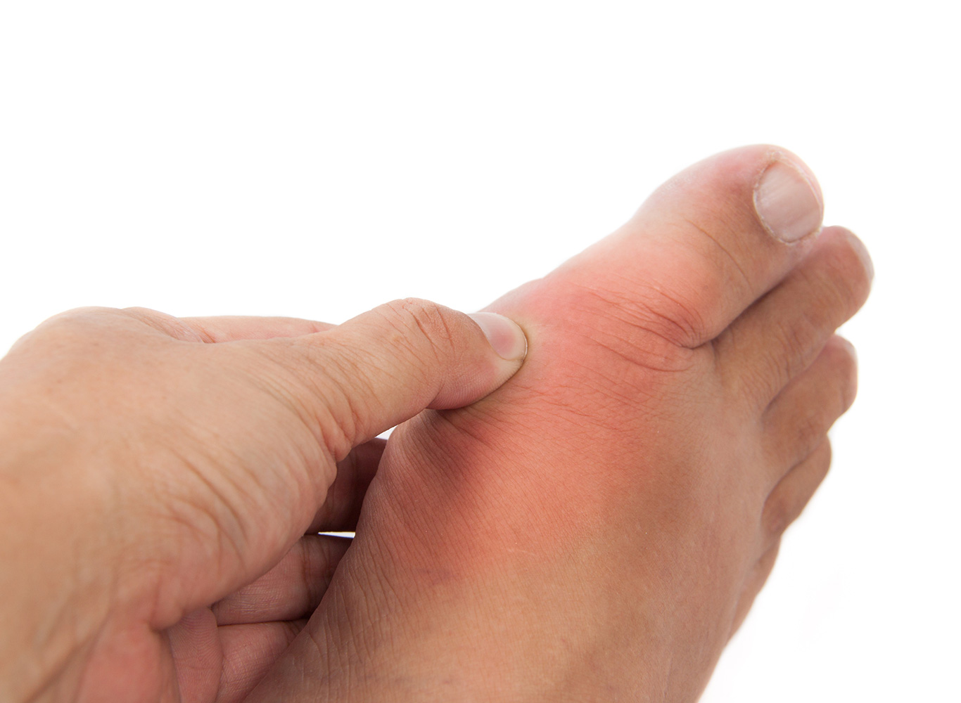 natural remedies for gout